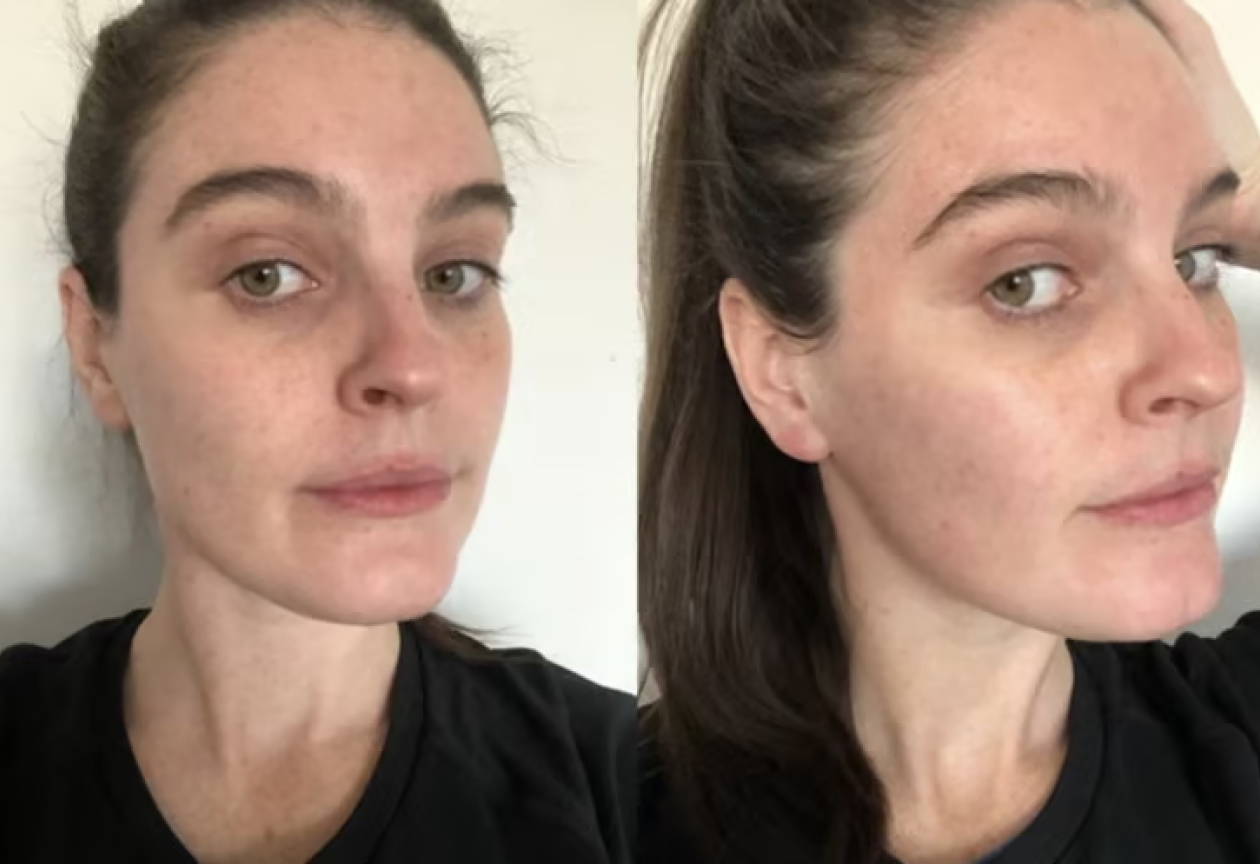 MicroSculpt MyDermaDream AU